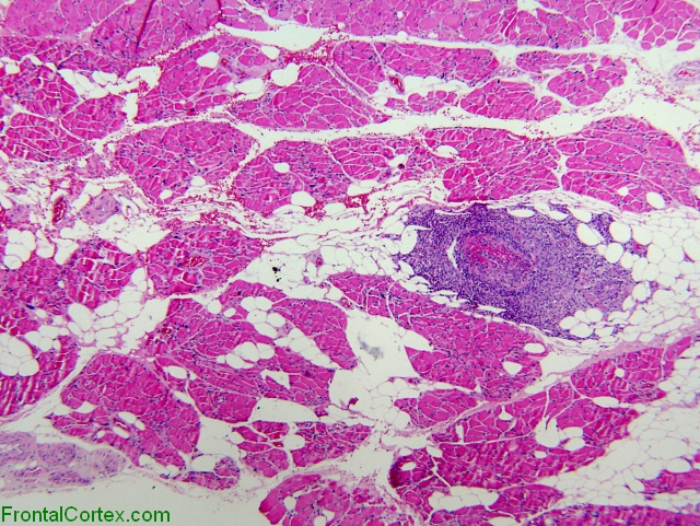 Churg Strauss arteritis on muscle biopsy, H&E stained section x 40